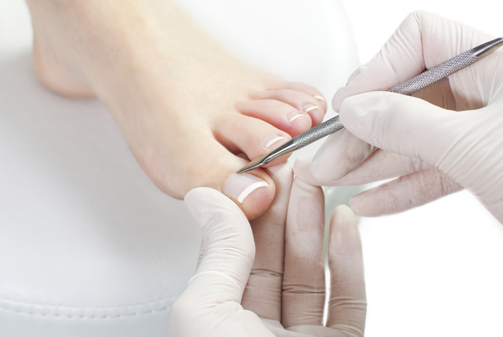 Ingrown Nails Surgery Image