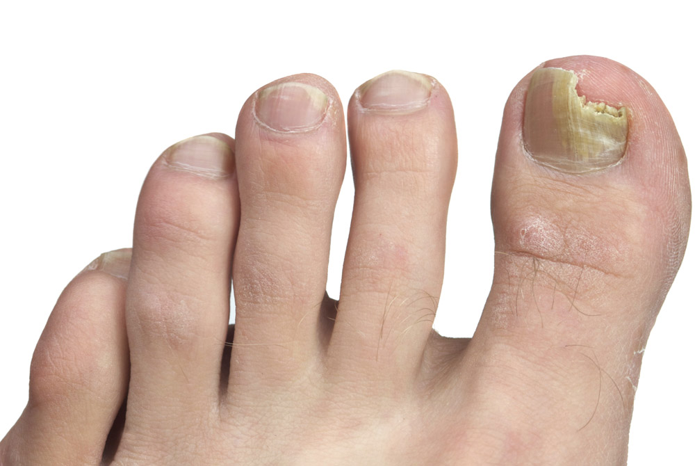 Nail Fungal Infection Image