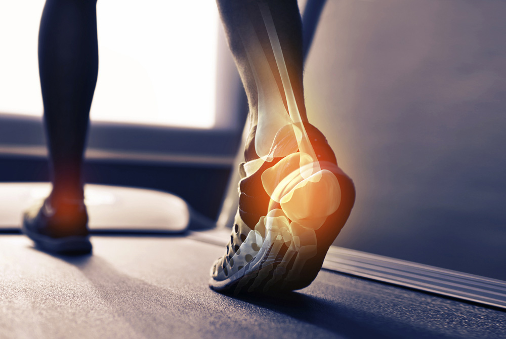 Plantar Fasciitis Image