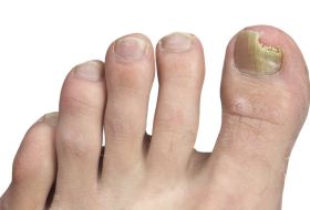 Nail fungal Infection