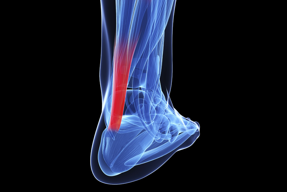 Achilles Tendonitis Image