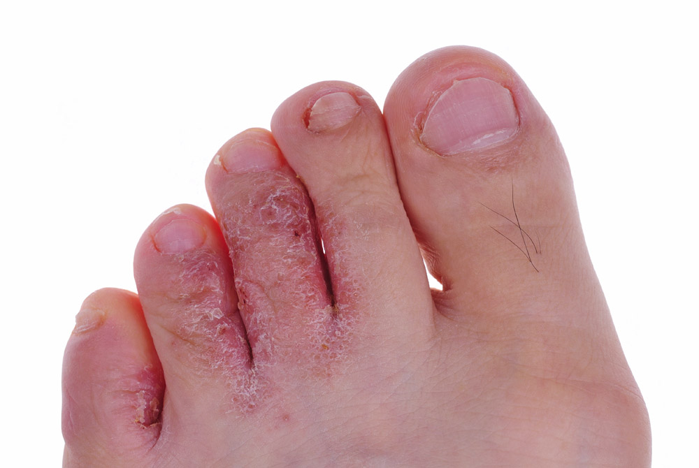 Athlete's Foot Image