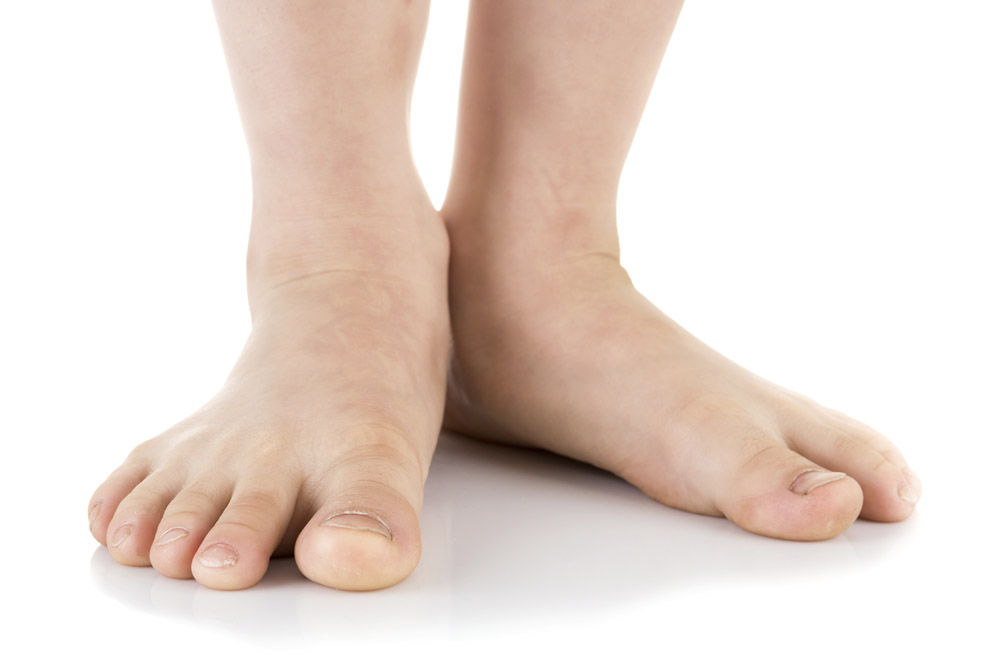 Flat Feet Image