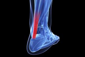 Achilles Tendonitis