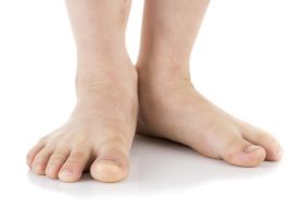 Flat Feet